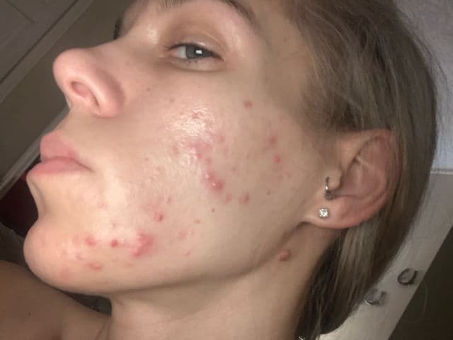 Murad Daily Clarifying Peel review photo by ReneeEgan