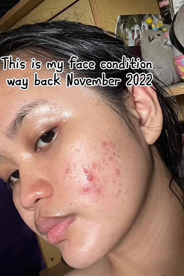 Ellana Cosmetics Clear Skin+ Clarifying Serum With 10% Azelaic Acid (Azeclair) review photo by heyitsannyang