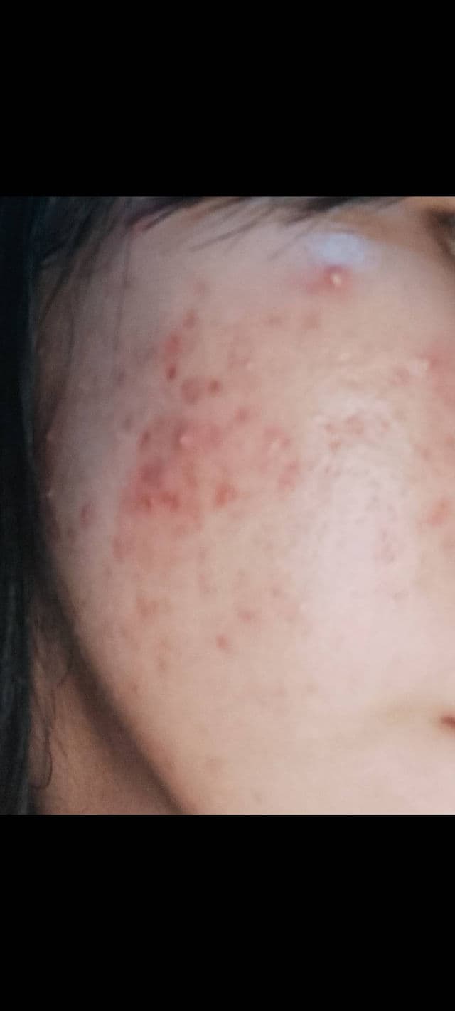 Azarine Calm My Acne Sunscreen Moisturiser SPF35 PA+++ review photo by ChuyXxs