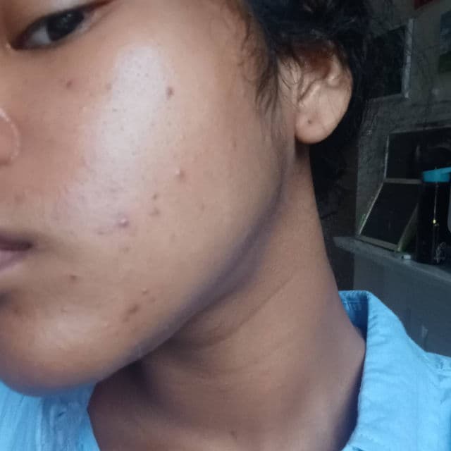 Some By Mi AHA BHA PHA 30 Days Miracle Cream review photo by maayland