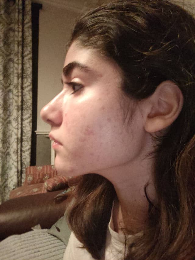Galderma Adapalene 0.3% + Benzoyl Peroxide 2.5% (Epiduo Forte) review photo by Inesschy