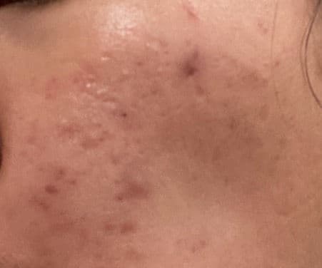 The Inkey List Tranexamic Acid Serum review photo by madeleinekim