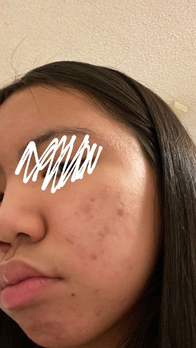 The Inkey List Tranexamic Acid Serum review photo by madeleinekim