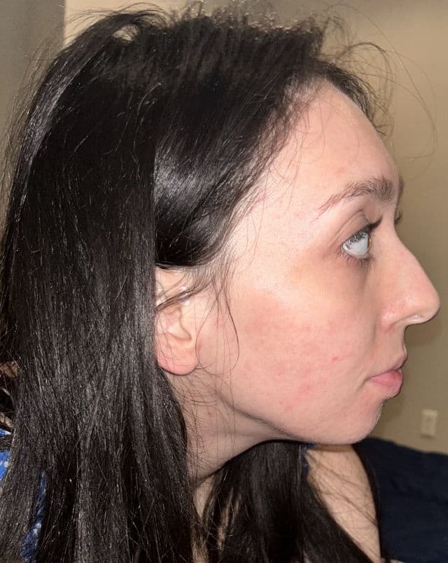 Bliss BlissPro Liquid Exfoliant review photo by 7fiand