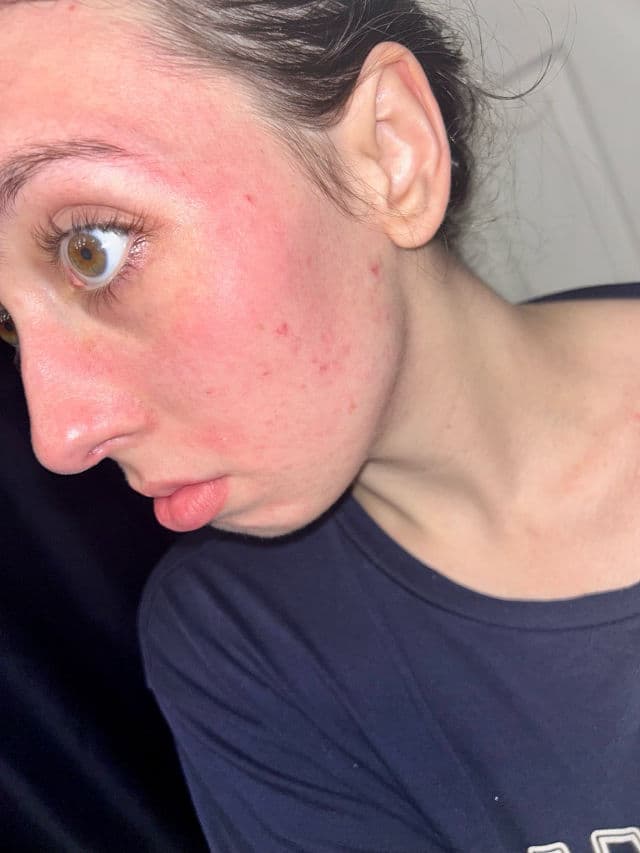 Bliss BlissPro Liquid Exfoliant review photo by 7fiand