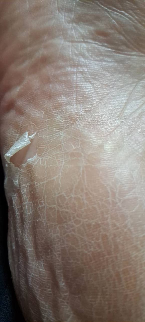 Purederm Exfoliating Heel Mask review photo by ladybird