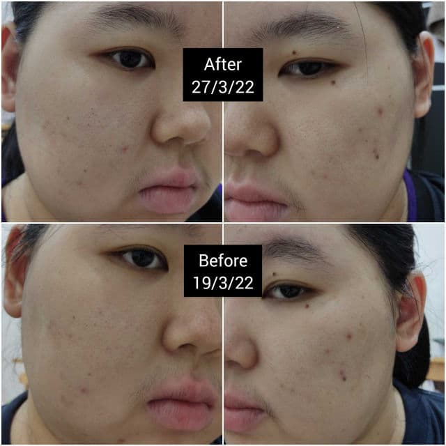 Nano White Arbutin + Niacinamide Spot Correction Advance Serum review photo by Muziz