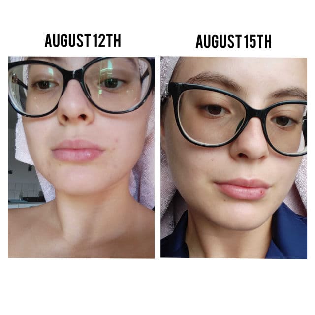 one.two.free! SOS Spot Eraser review photo by skincareandcaro