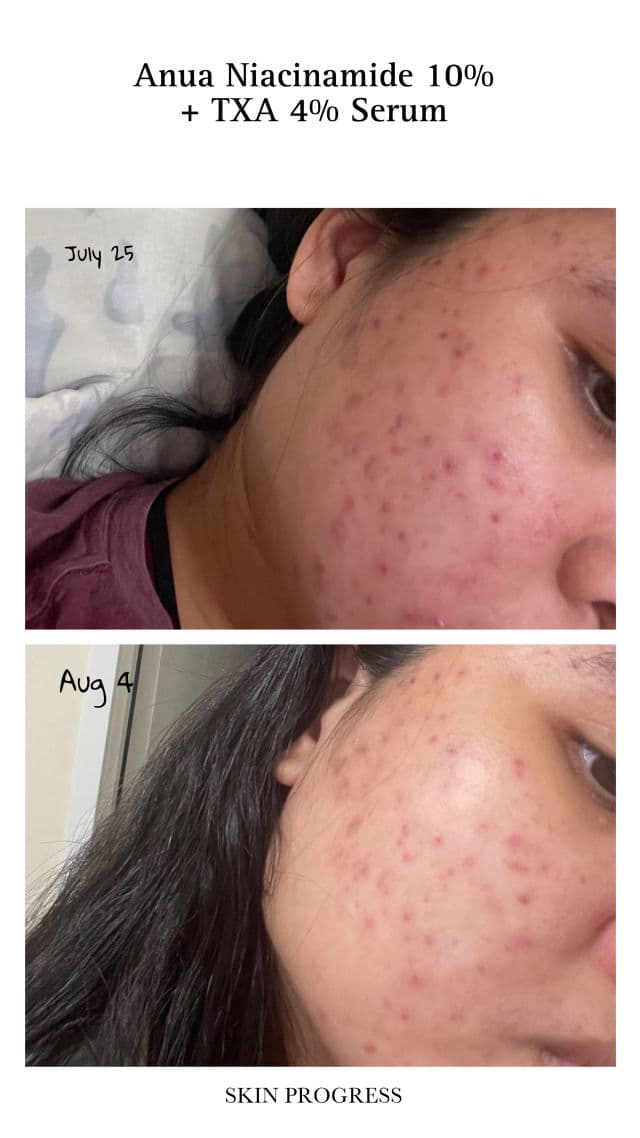 Niacinamide 10% + TXA 4% Dark Spot Correcting Serum product review