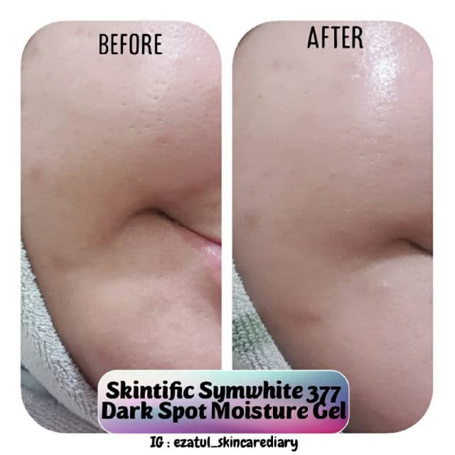 Skintific Symwhite 377 Dark Spot Moisture Gel review photo by ezatulSkincareDiary