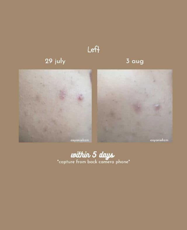 AXIS-Y PHA Resurfacing Glow Peel review photo by asyanie