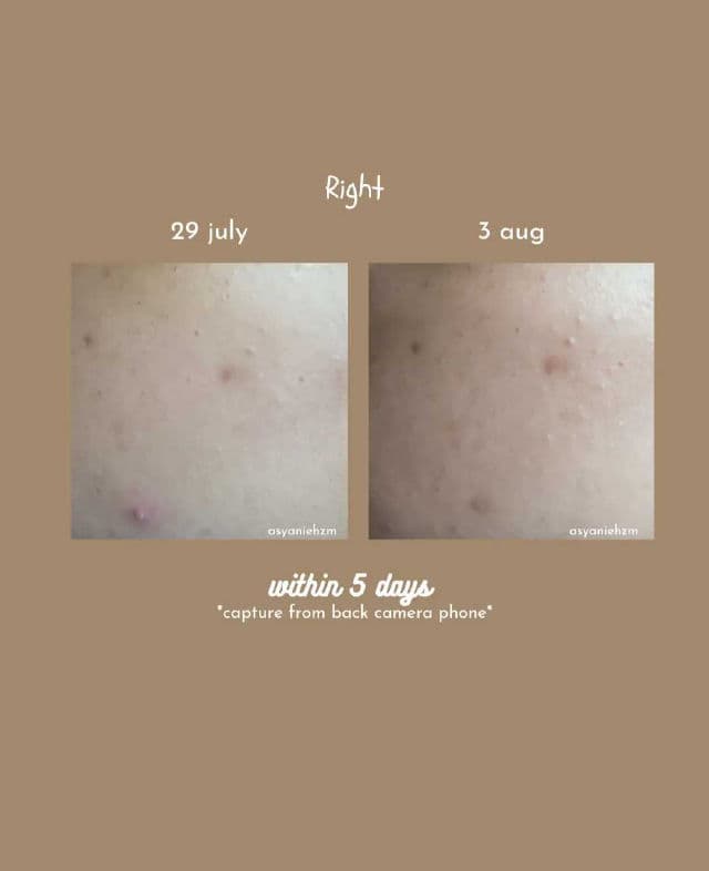 AXIS-Y PHA Resurfacing Glow Peel review photo by asyanie