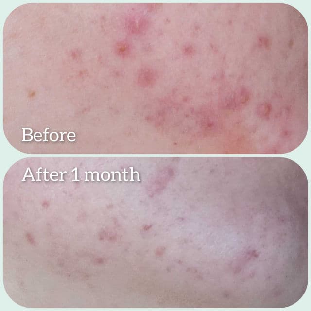 La Roche-Posay Effaclar Duo Plus review photo by Alca