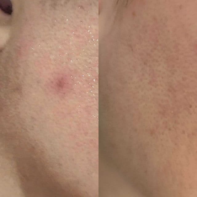 CELIMAX Jiwoogae Heartleaf BHA Peeling Pad review photo by elaineganuelas