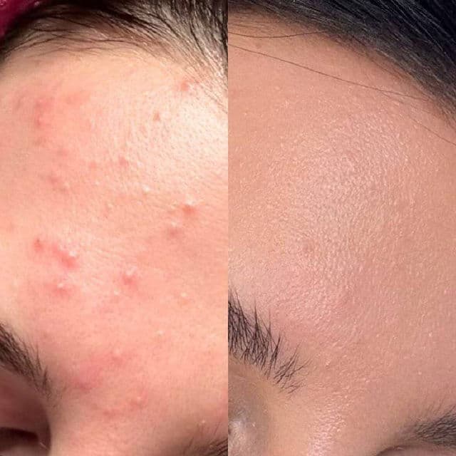 Jenpharm MandelAC Facewash review photo by zainab90