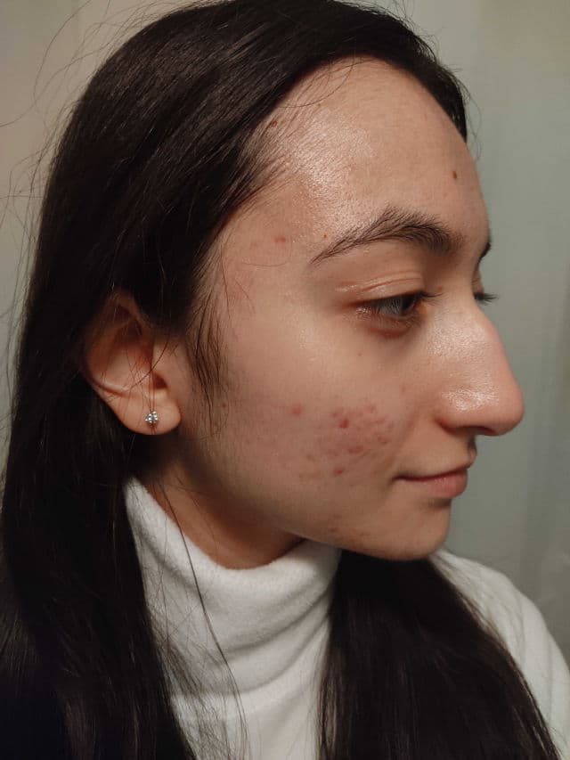 The Potions Hyaluronic Acid Ampoule review photo by alphahydRoxy