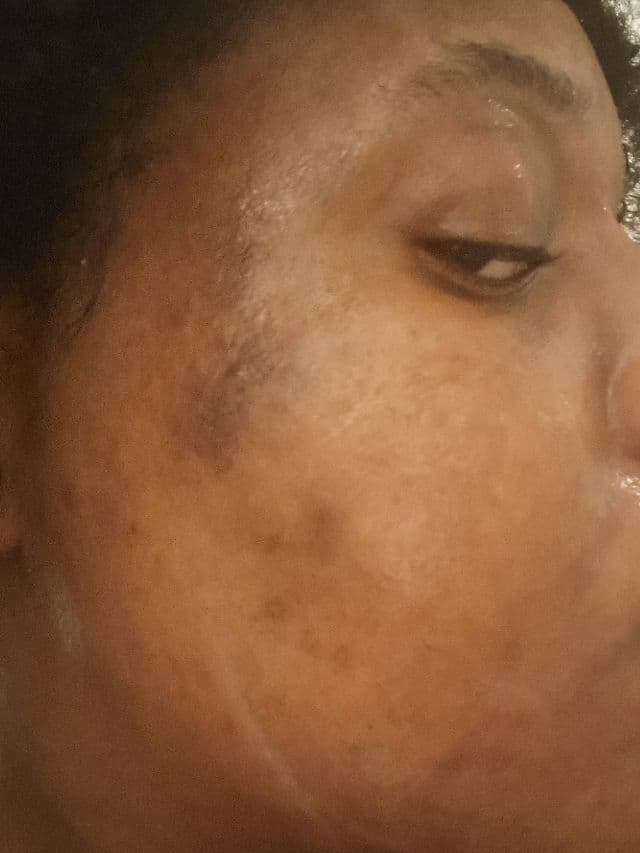 Best hyperpigmentation products routine