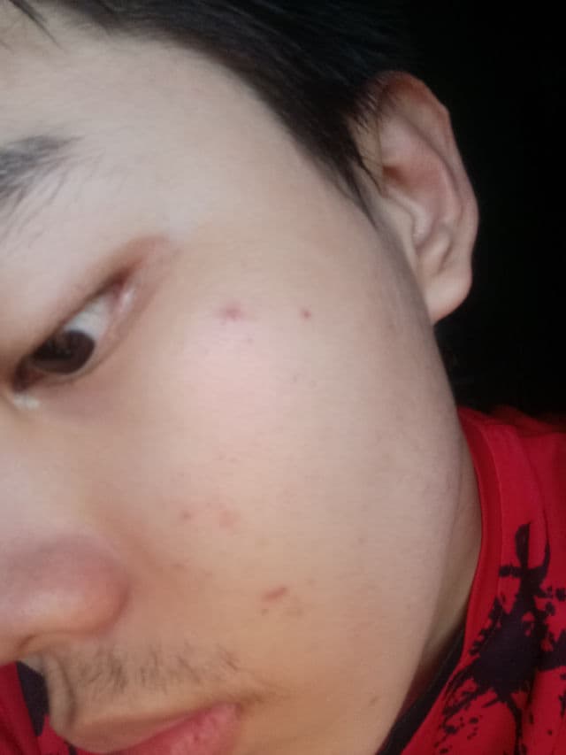Sariayu Intensive Acne Care review photo by ALPINOprananda