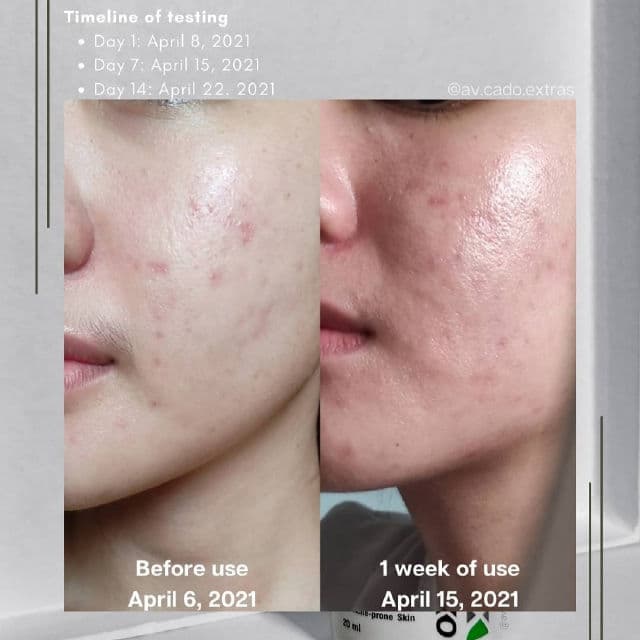 Oxecure Acne Defense Prebio Serum  review photo by AVCado