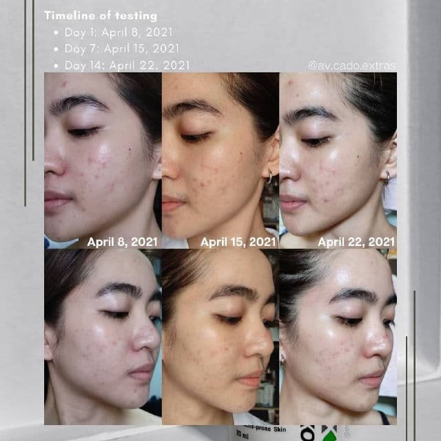Oxecure Acne Defense Prebio Serum  review photo by AVCado