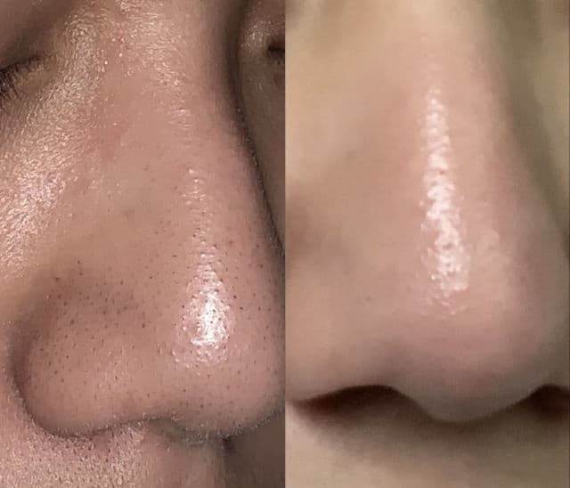 iWhite Korea The Original Nose Pack review photo by Acdv