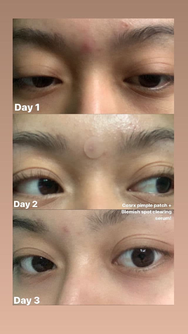 COSRX AC Collection Blemish Spot Clearing Serum review photo by Acdv