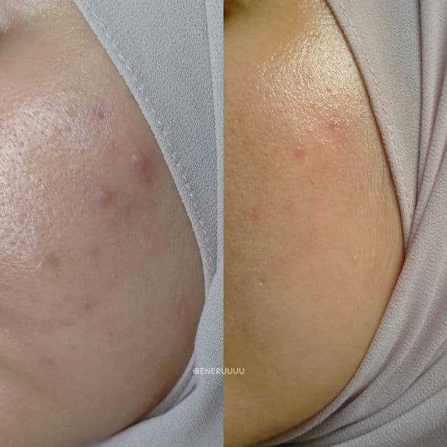 HAUM LCID Salicylic Acid 2% review photo by Eneruuuu