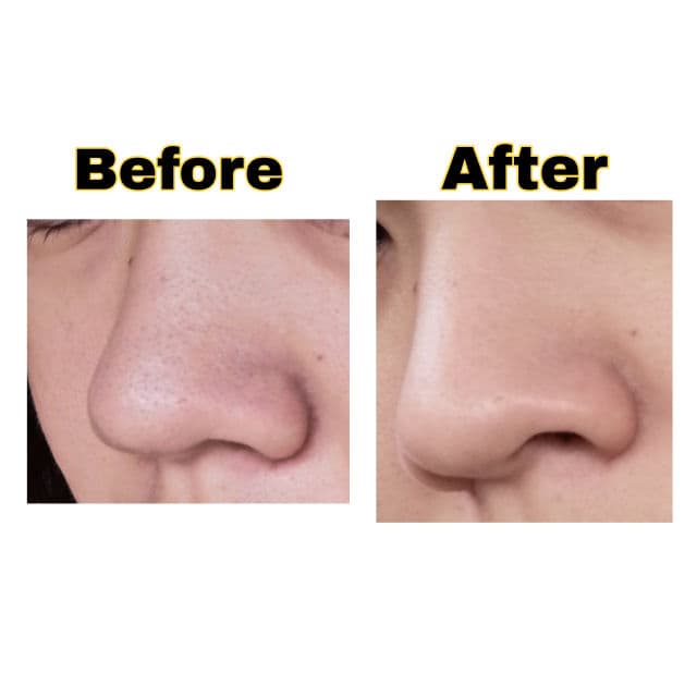 TIAM Blackhead Out Sheet review photo by GracyGrace