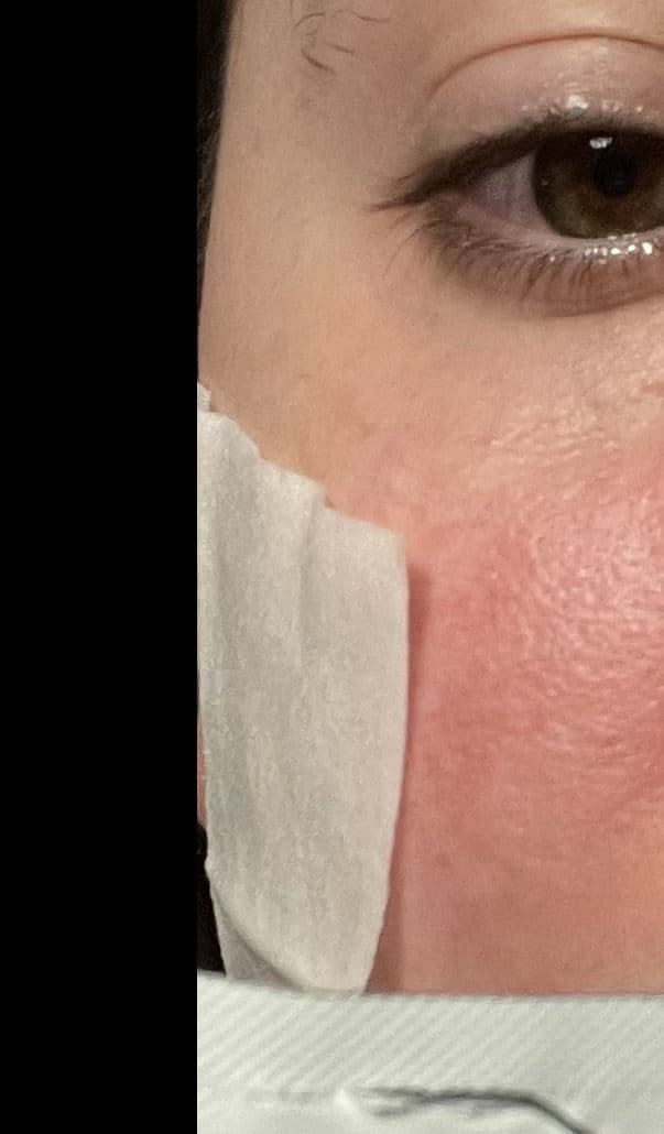 Dr. Dennis Gross Skincare Alpha Beta Universal Daily Peel - Step 2 review photo by Hebskin