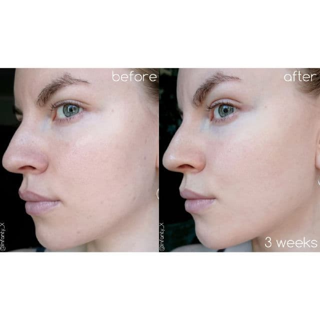 RNW DER. Concentrate Niacinamide Plus review photo by TanyaKbeauty