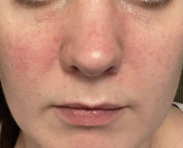 Superdrug Naturally Radiant Glycolic Tonic 5% review photo by Hebskin