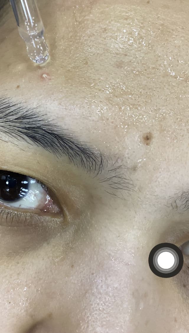 Azarine Anti Acne & Brightening Serum  review photo by JuliaAlly