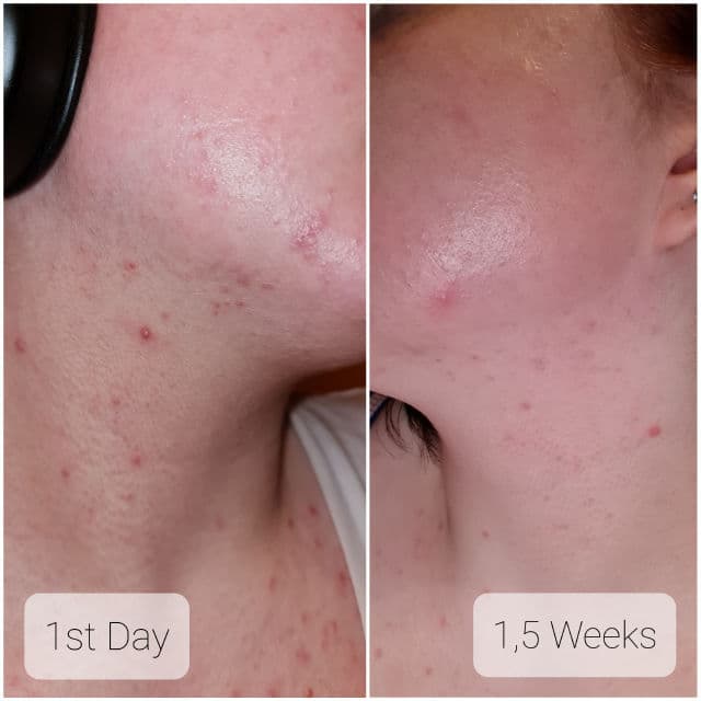 La Roche-Posay Effaclar Foaming Purifying Gel review photo by KHHLuv