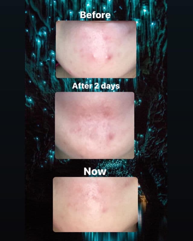 J'sDerma Acnetrix Control AC Serum review photo by Kaiiixx