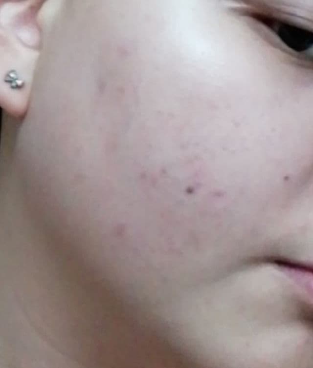 Rohto Mentholatum Melano CC Intensive Anti-Spot Essence review photo by Leovine