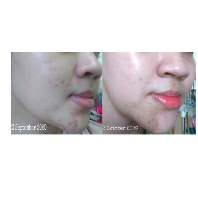 Scarlett Whitening Brightly Ever After Serum review photo by Noeksecin