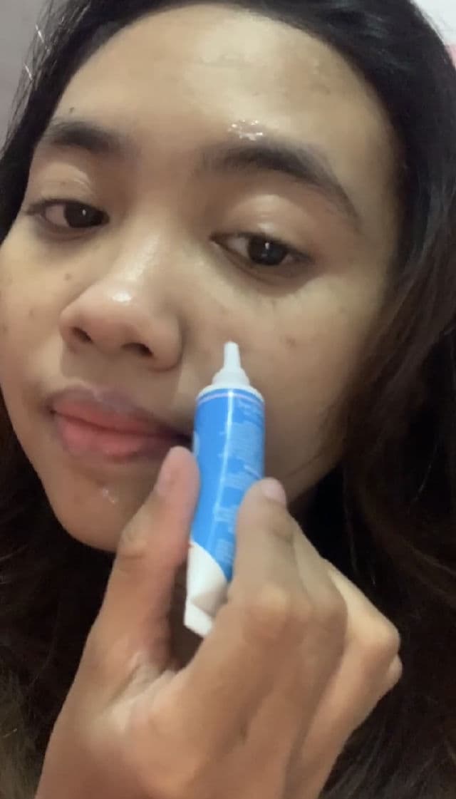Acnol Gel for Acne review photo by Novella