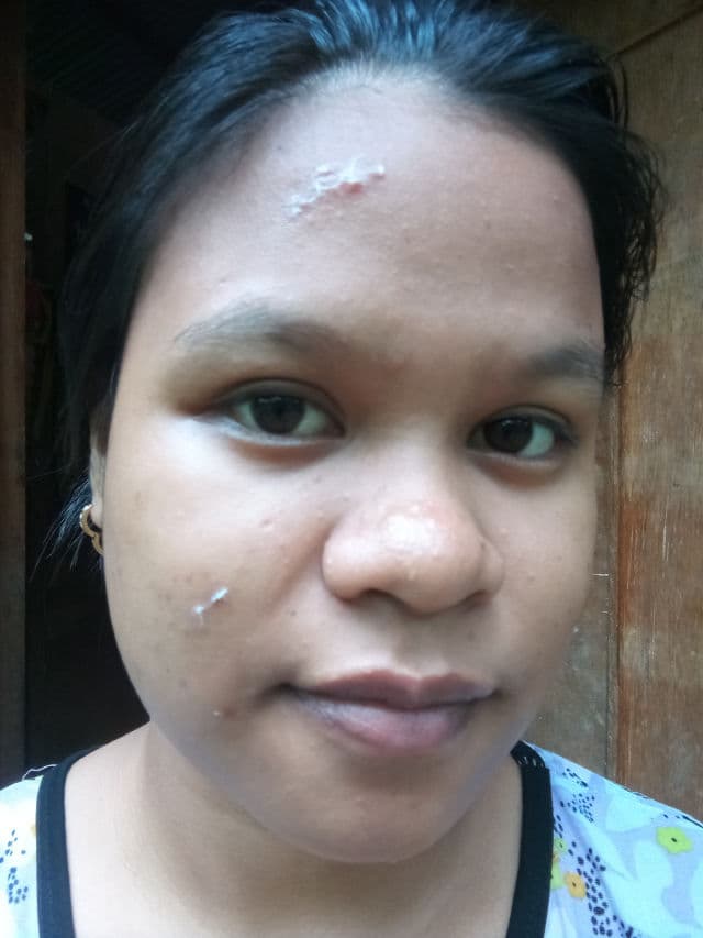 Hello Glow Pore Acne Spot Drying Cream review photo by PickyBel