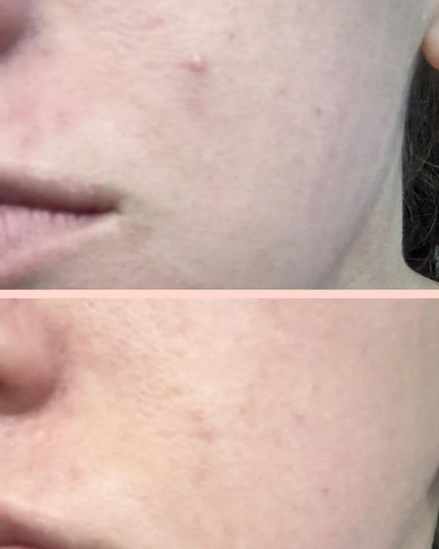 IMIM Acne Repairing Treatment review photo by Renterese