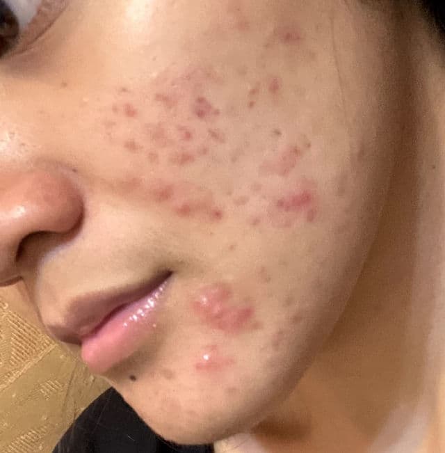 COSRX Salicylic Acid Daily Gentle Cleanser review photo by Sharonn