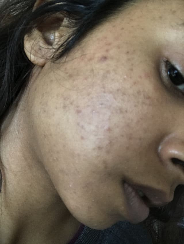 The Ordinary Retinol 1% in Squalane review photo by Sheyshey