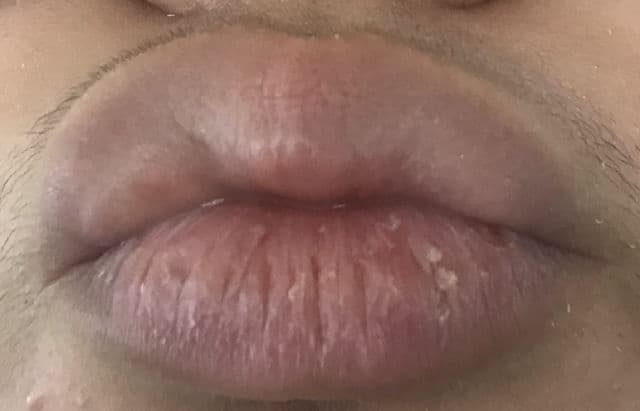 Blistex Lip Medex® review photo by Sydney