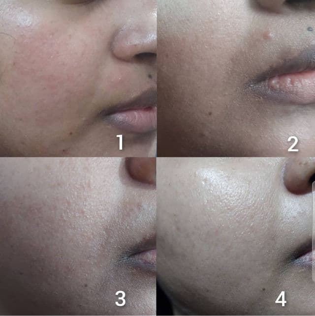 pulp Ex-Acne Acne Treatment Superfood Serum review photo by Tapaswini