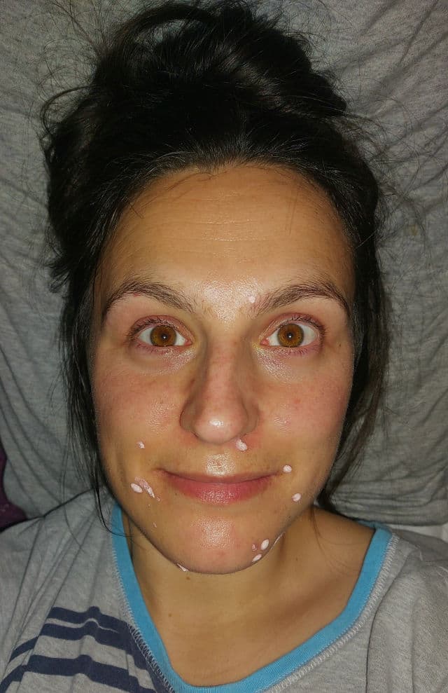Kate Somerville EradiKate Acne Treatment review photo by Teleahk