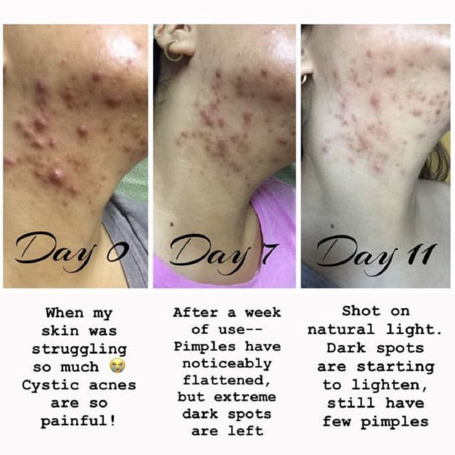 Apotheke Science Spot Treatment review photo by TheGeekyBeaute