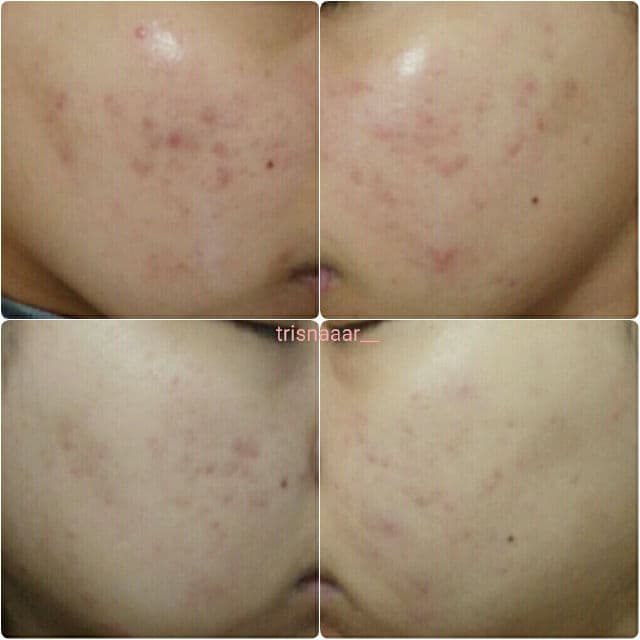 SKIN1004 [Discontinued] Madagascar Centella Asiatica 100 Ampoule review photo by Trisnaar