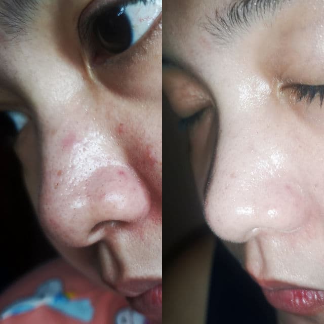 COSRX AC Collection Calming Foam Cleanser review photo by Vheneth