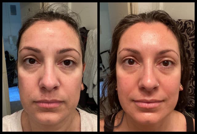 Dermatica Tretinoin + 4% Niacinamide review photo by ViviBogdanov