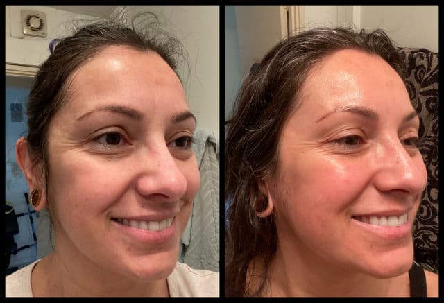 Dermatica Tretinoin + 4% Niacinamide review photo by ViviBogdanov