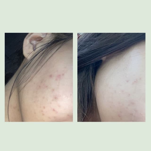 Now and After Acne Solution Spot Gel review photo by Yashaaachan
